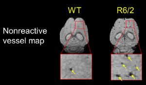 Aberrant Astrocytes
