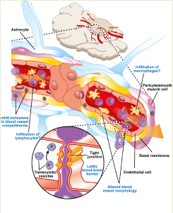 Figure: The main cerebrovascular compromise in HD patients and in an HD mouse model of the disease, comprised of mhtt expression in cell types associated with blood vessels, the alteration of blood vessel morphology and an increase in blood-brain barrier permeability 