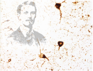 Figure: (Background) Pathological tau aggregates in an HD brain (Foreground left) George Huntington, MD (1850−1916), who first described the disease that now bears his name, in a report titled “On chorea” published in The Medical and Surgical Reporter of Philadelphia on April 13, 1872