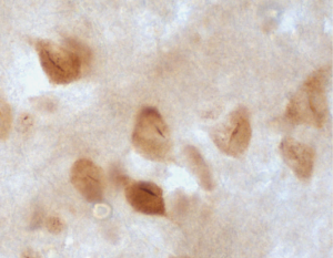 Figure: Tau nuclear rods (TNRs), a newly identified kind of tau deposit in the brains of individuals with HD